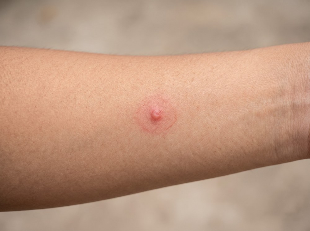 Close-up of a fresh fire ant sting showing a red welt topped with a small white pustule